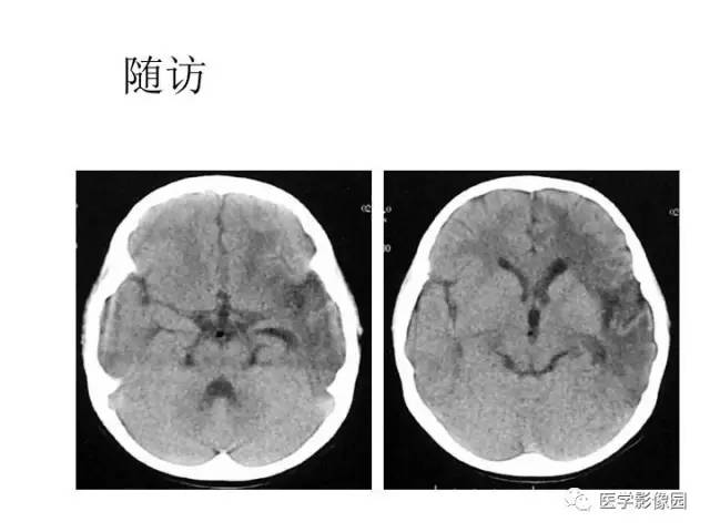 【PPT】婴幼儿中枢神经感染的CT/MRI特征分析