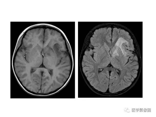 【PPT】婴幼儿中枢神经感染的CT/MRI特征分析