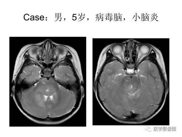 【PPT】婴幼儿中枢神经感染的CT/MRI特征分析