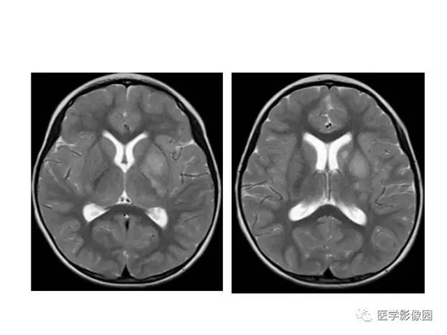 【PPT】婴幼儿中枢神经感染的CT/MRI特征分析