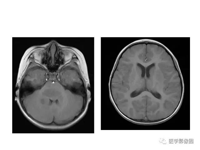 【PPT】婴幼儿中枢神经感染的CT/MRI特征分析