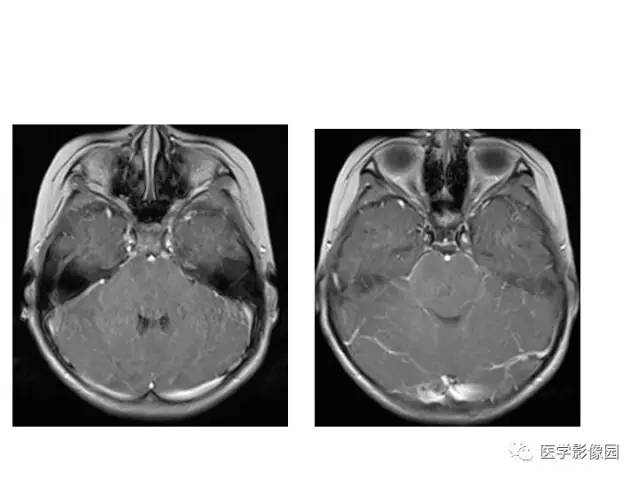 【PPT】婴幼儿中枢神经感染的CT/MRI特征分析