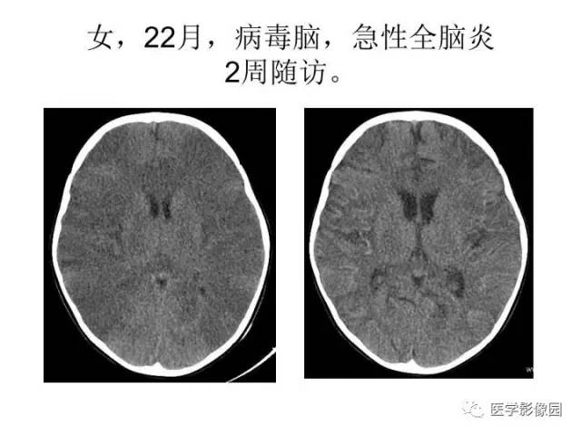 【PPT】婴幼儿中枢神经感染的CT/MRI特征分析