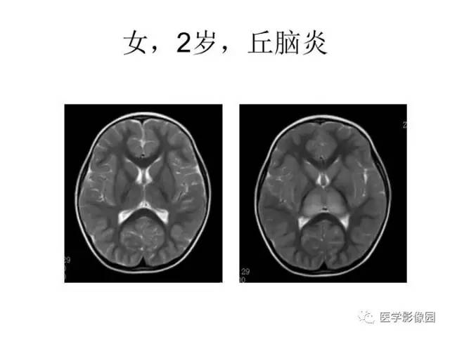 【PPT】婴幼儿中枢神经感染的CT/MRI特征分析