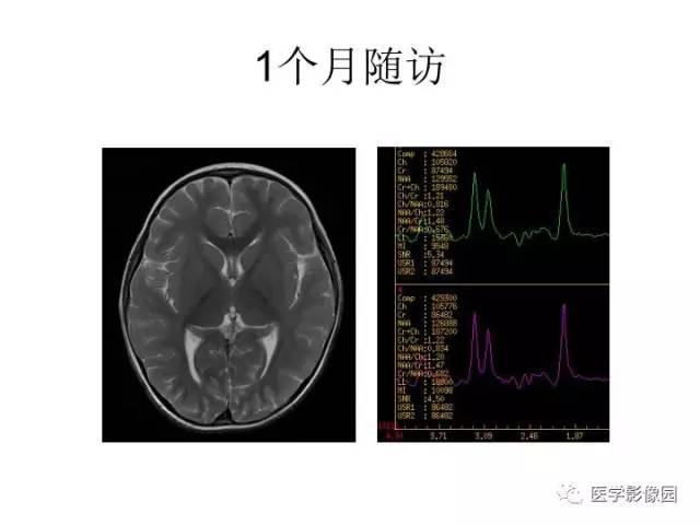 【PPT】婴幼儿中枢神经感染的CT/MRI特征分析