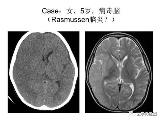 【PPT】婴幼儿中枢神经感染的CT/MRI特征分析