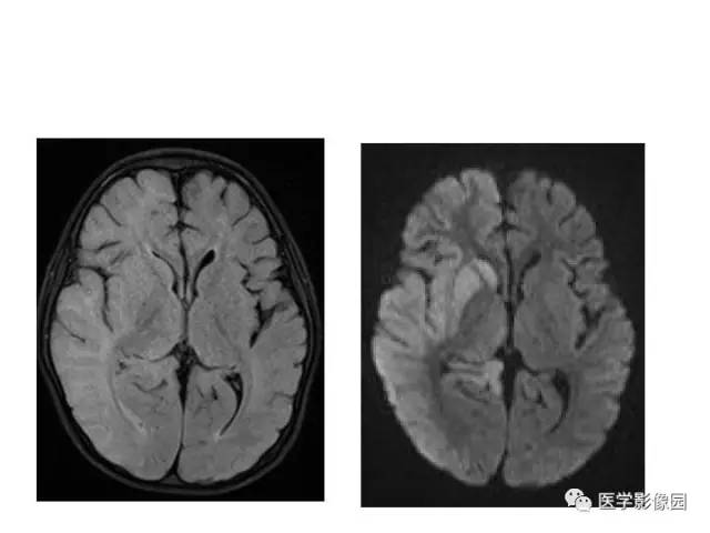 【PPT】婴幼儿中枢神经感染的CT/MRI特征分析