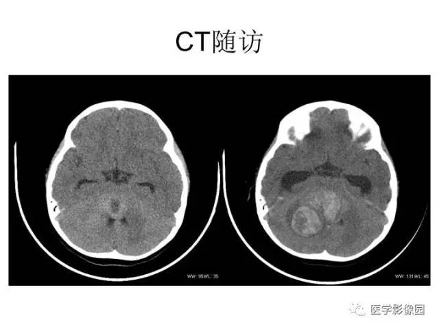 【PPT】婴幼儿中枢神经感染的CT/MRI特征分析