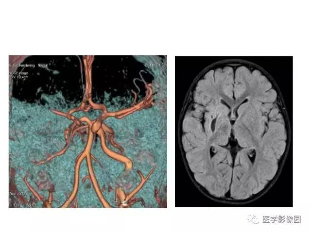 【PPT】婴幼儿中枢神经感染的CT/MRI特征分析