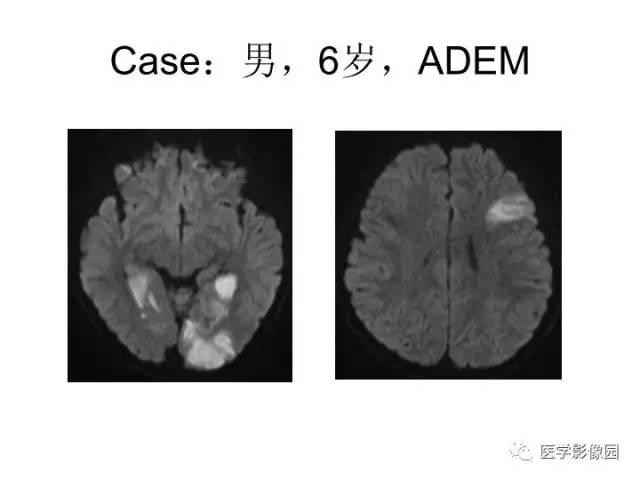 【PPT】婴幼儿中枢神经感染的CT/MRI特征分析