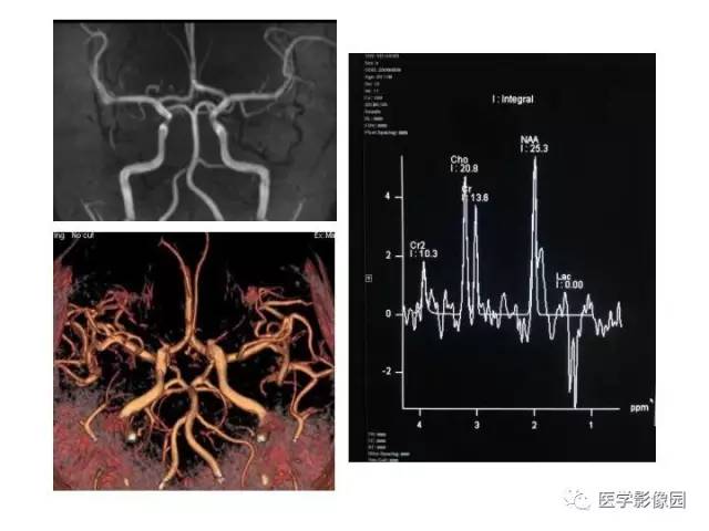 【PPT】婴幼儿中枢神经感染的CT/MRI特征分析