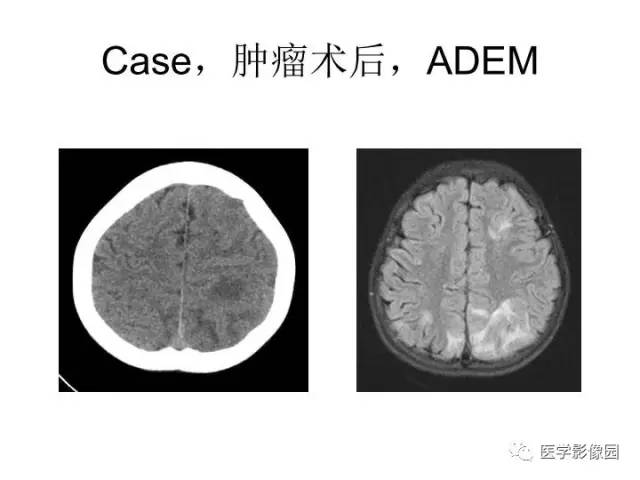 【PPT】婴幼儿中枢神经感染的CT/MRI特征分析