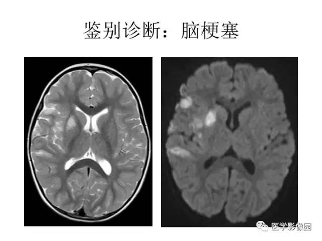 【PPT】婴幼儿中枢神经感染的CT/MRI特征分析