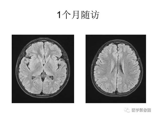 【PPT】婴幼儿中枢神经感染的CT/MRI特征分析