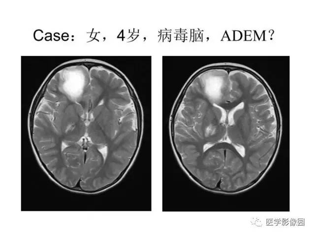 【PPT】婴幼儿中枢神经感染的CT/MRI特征分析