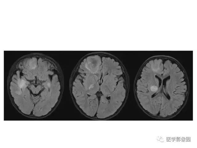 【PPT】婴幼儿中枢神经感染的CT/MRI特征分析