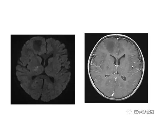 【PPT】婴幼儿中枢神经感染的CT/MRI特征分析