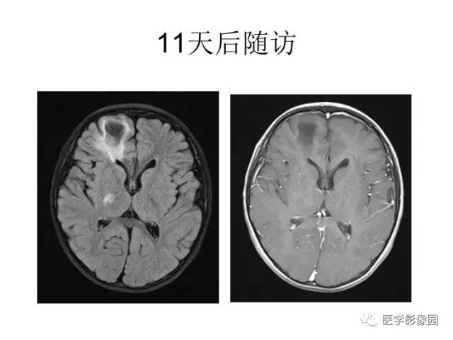 【PPT】婴幼儿中枢神经感染的CT/MRI特征分析