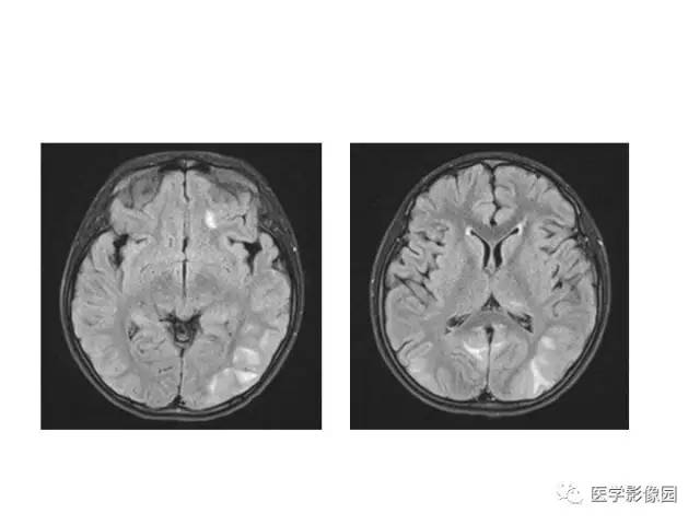 【PPT】婴幼儿中枢神经感染的CT/MRI特征分析