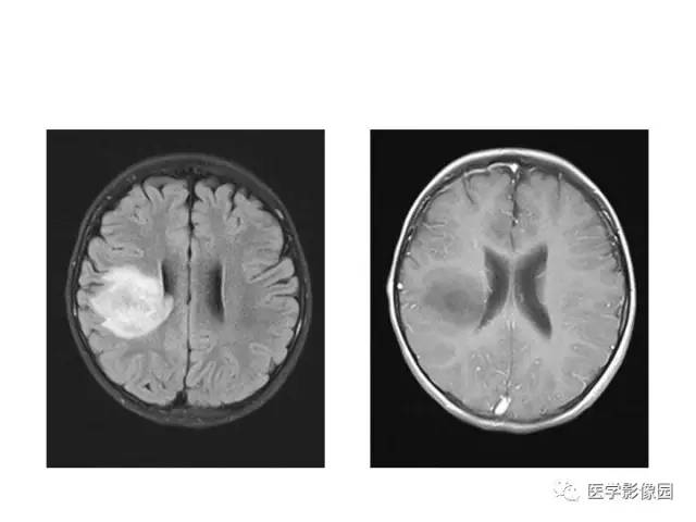 【PPT】婴幼儿中枢神经感染的CT/MRI特征分析