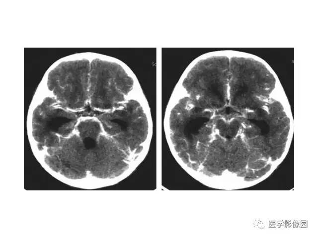 【PPT】婴幼儿中枢神经感染的CT/MRI特征分析