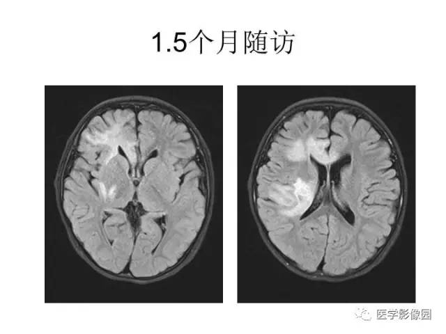【PPT】婴幼儿中枢神经感染的CT/MRI特征分析
