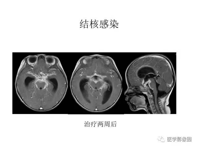 【PPT】婴幼儿中枢神经感染的CT/MRI特征分析