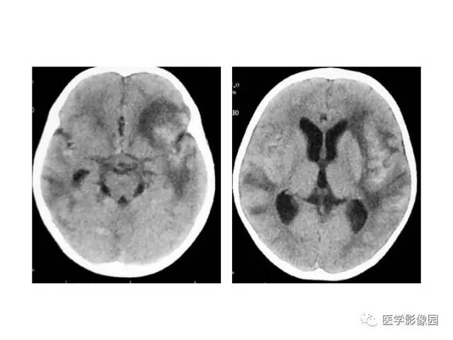 【PPT】婴幼儿中枢神经感染的CT/MRI特征分析