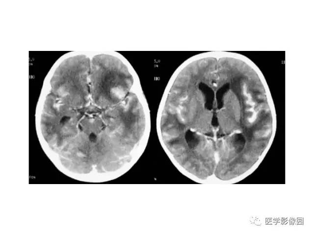 【PPT】婴幼儿中枢神经感染的CT/MRI特征分析