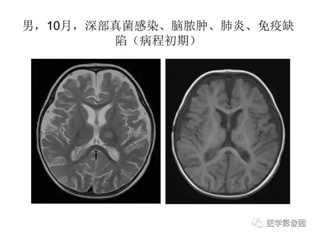 【PPT】婴幼儿中枢神经感染的CT/MRI特征分析