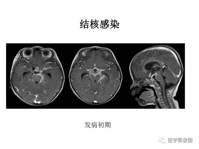 【PPT】婴幼儿中枢神经感染的CT/MRI特征分析