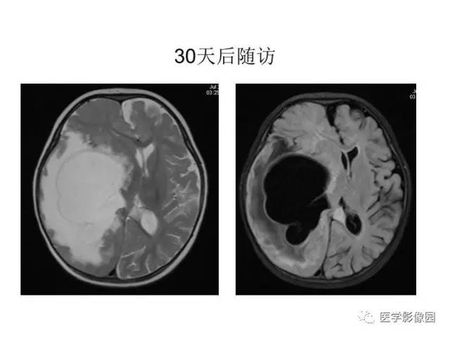 【PPT】婴幼儿中枢神经感染的CT/MRI特征分析