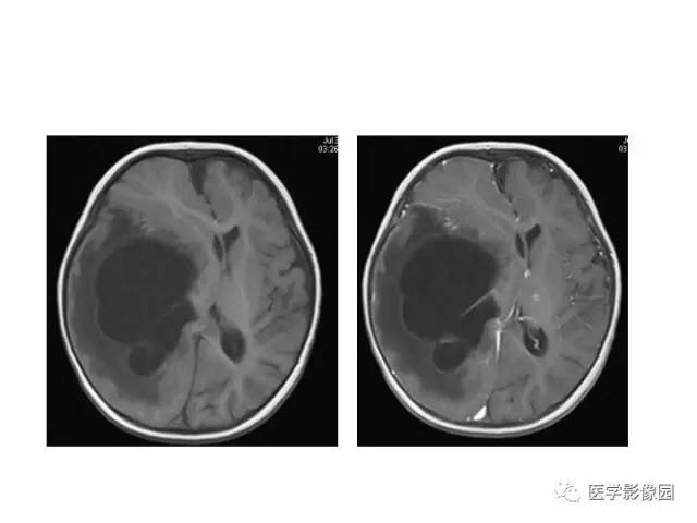 【PPT】婴幼儿中枢神经感染的CT/MRI特征分析