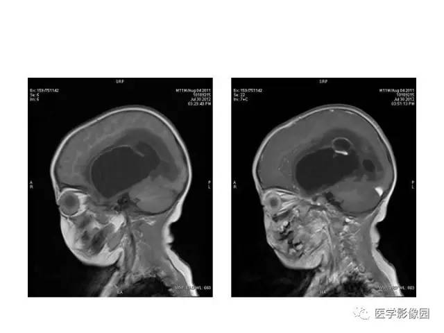 【PPT】婴幼儿中枢神经感染的CT/MRI特征分析