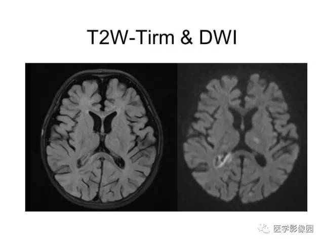 【PPT】婴幼儿中枢神经感染的CT/MRI特征分析