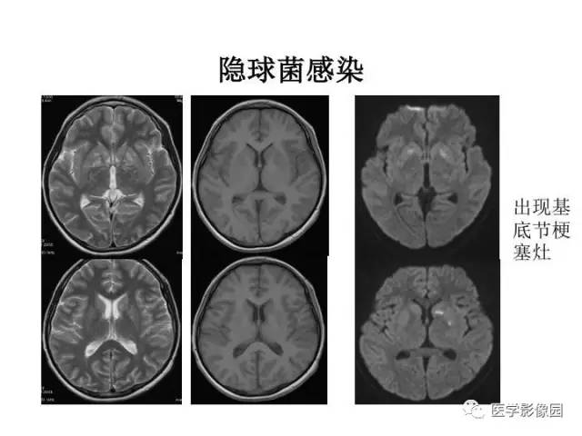 【PPT】婴幼儿中枢神经感染的CT/MRI特征分析
