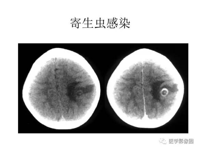 【PPT】婴幼儿中枢神经感染的CT/MRI特征分析