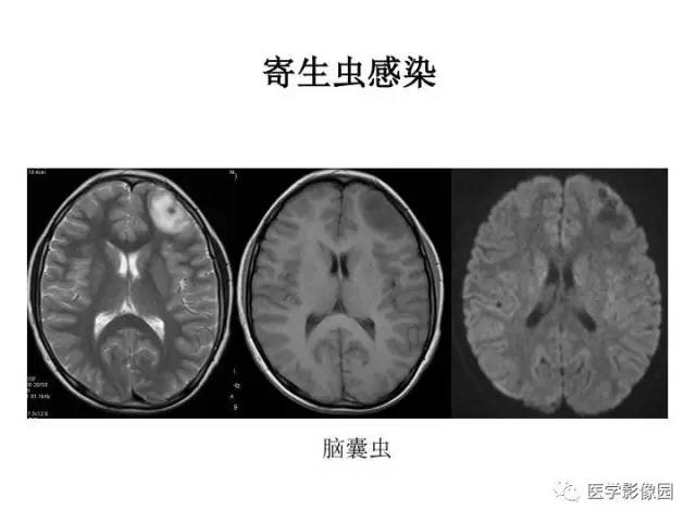 【PPT】婴幼儿中枢神经感染的CT/MRI特征分析