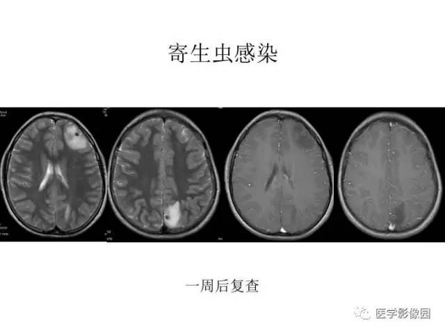 【PPT】婴幼儿中枢神经感染的CT/MRI特征分析