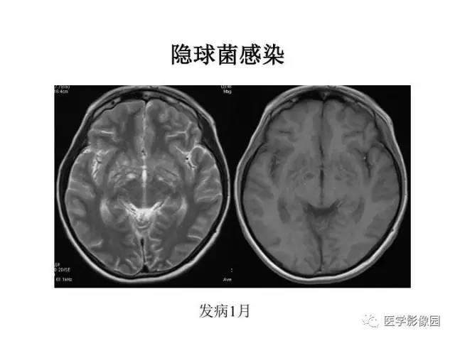 【PPT】婴幼儿中枢神经感染的CT/MRI特征分析