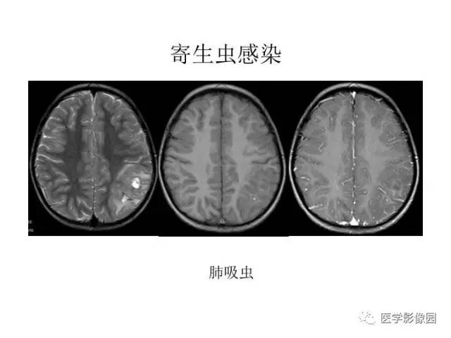 【PPT】婴幼儿中枢神经感染的CT/MRI特征分析