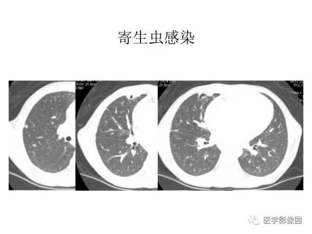 【PPT】婴幼儿中枢神经感染的CT/MRI特征分析