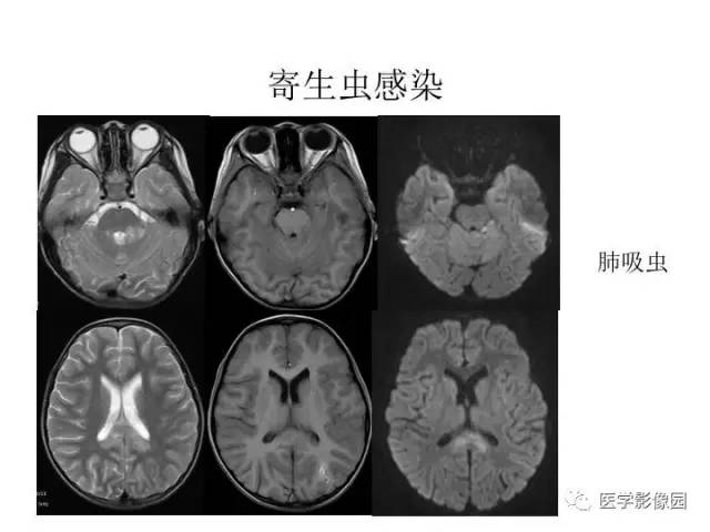 【PPT】婴幼儿中枢神经感染的CT/MRI特征分析