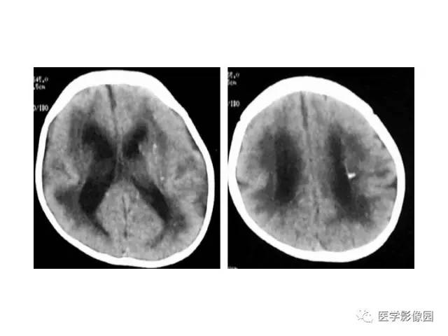 【PPT】婴幼儿中枢神经感染的CT/MRI特征分析