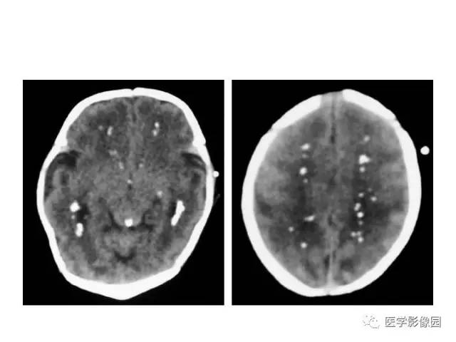 【PPT】婴幼儿中枢神经感染的CT/MRI特征分析