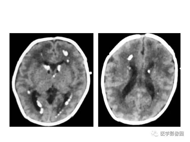 【PPT】婴幼儿中枢神经感染的CT/MRI特征分析