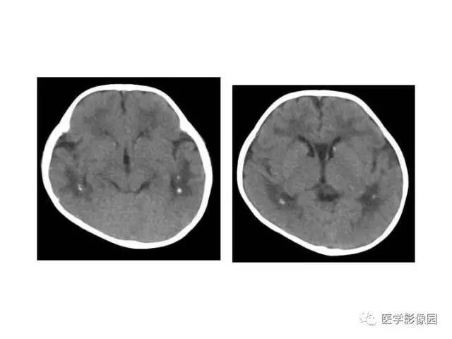 【PPT】婴幼儿中枢神经感染的CT/MRI特征分析