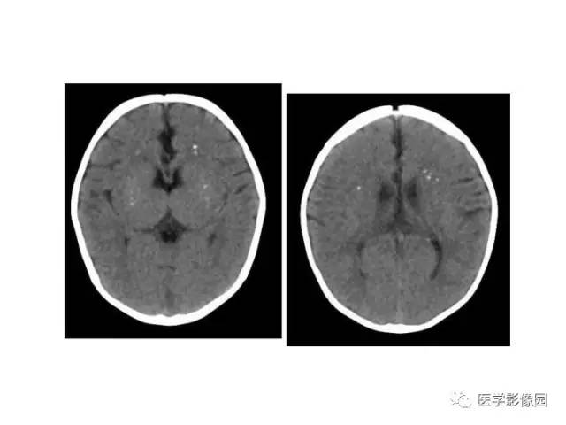 【PPT】婴幼儿中枢神经感染的CT/MRI特征分析
