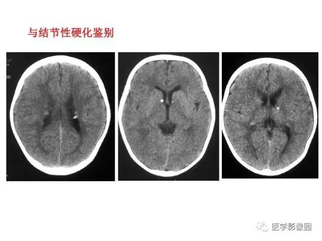 【PPT】婴幼儿中枢神经感染的CT/MRI特征分析
