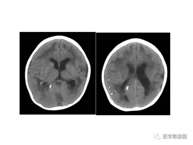【PPT】婴幼儿中枢神经感染的CT/MRI特征分析